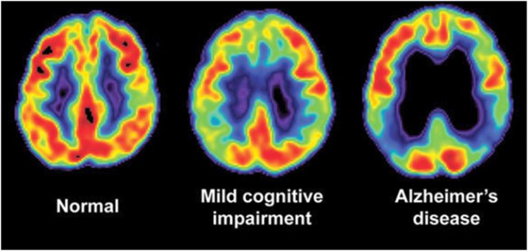 Diagnosticarea Alzheimer, un nou test sangvin